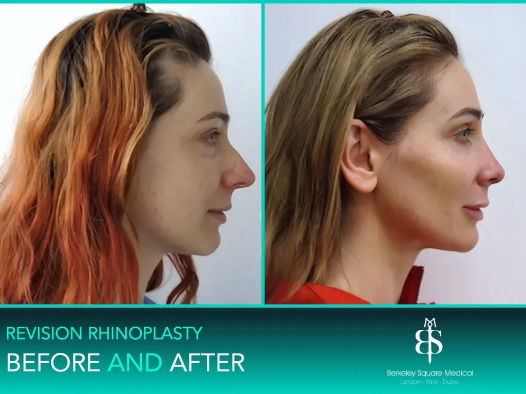 Revision rhinoplasty before and after, side profile: smoother bridge and refined tip, Mr Taimur Shoaib, London