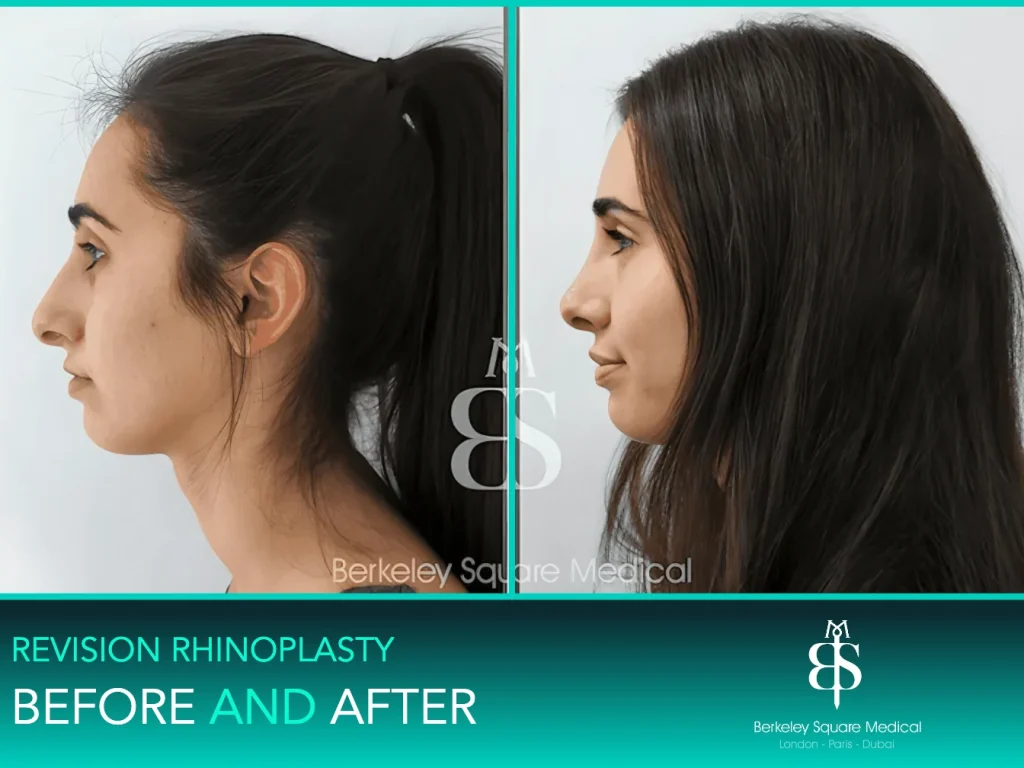 Revision rhinoplasty before and after, side profile: hump reduced for a straighter profile, Mr Taimur Shoaib, London