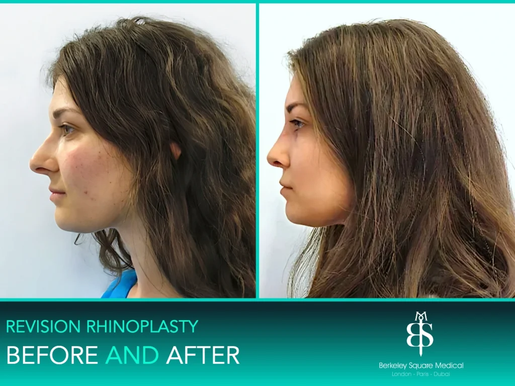 Revision rhinoplasty before and after, side profile: hump smoothed for a straighter bridge, Mr Taimur Shoaib, London