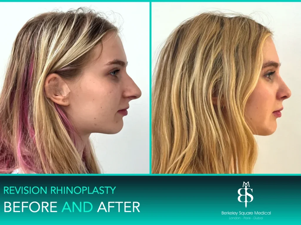 Revision rhinoplasty before and after, side profile: straighter bridge and a lifted tip, Mr Taimur Shoaib, London