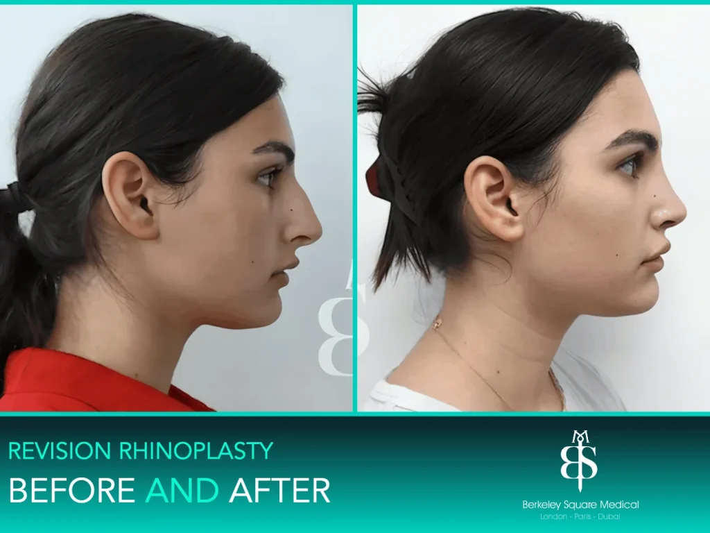 Revision rhinoplasty before and after, side profile: hump reduced for a straight bridge, Mr Taimur Shoaib, London