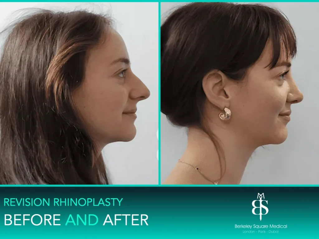 Revision rhinoplasty before and after, side profile: hump reduced for a straighter bridge, Mr Taimur Shoaib, London