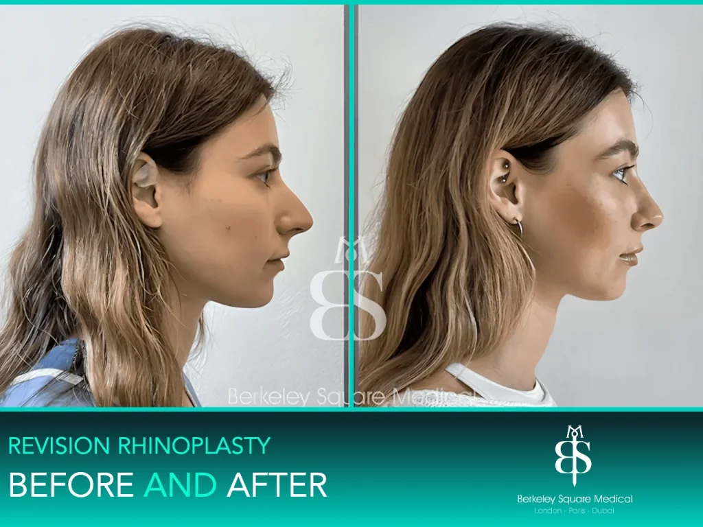 Revision rhinoplasty before and after, side profile: smoother bridge and a better-balanced tip, Mr Taimur Shoaib, London