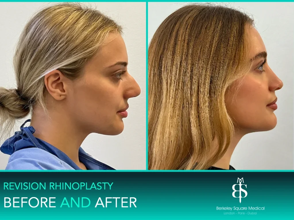 Revision rhinoplasty before and after, side profile: smoother bridge and refined tip, Mr Taimur Shoaib, London
