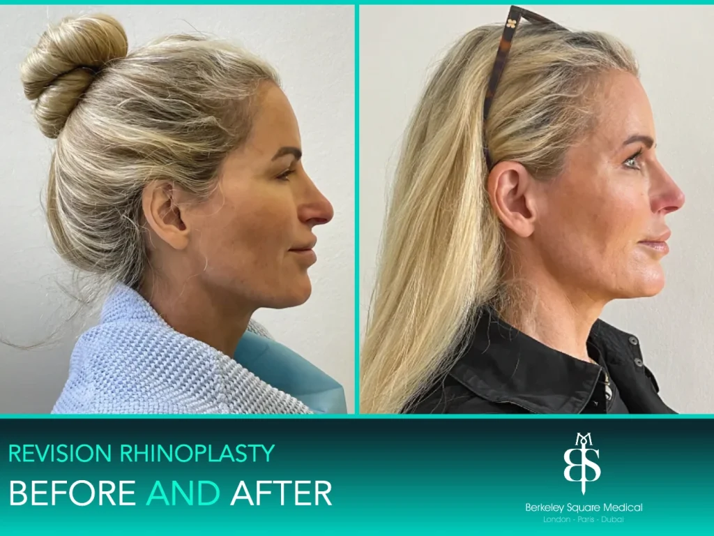 Revision rhinoplasty before and after, side profile: a smoother bridge line, Mr Taimur Shoaib, London