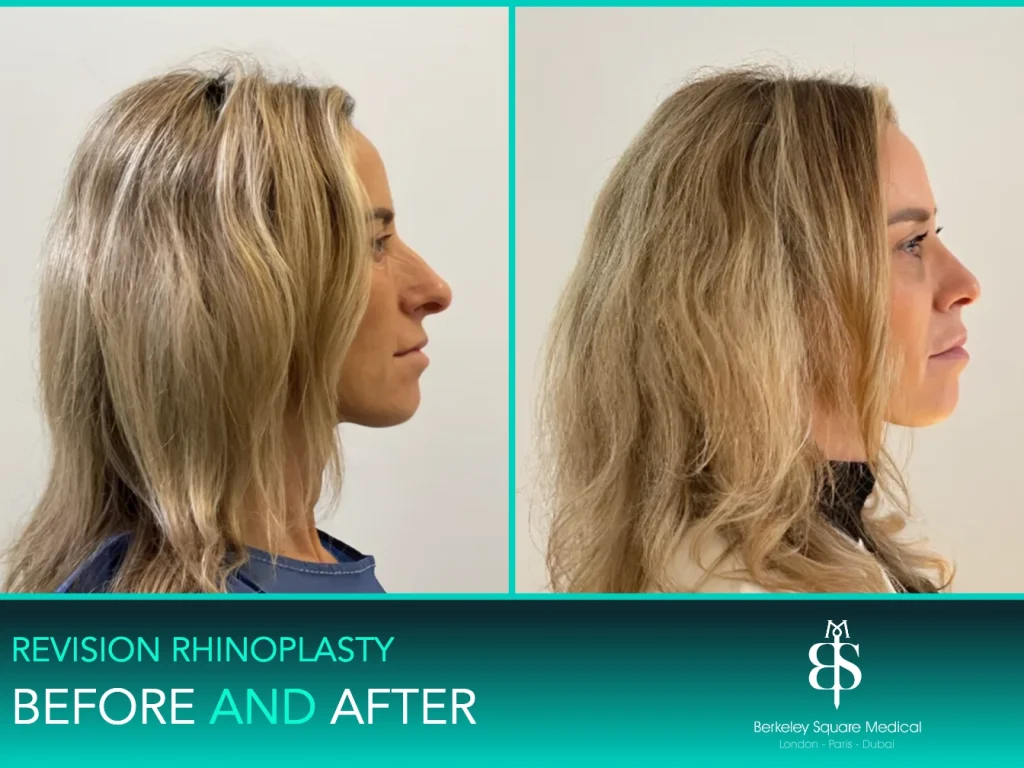 Revision rhinoplasty before and after, side profile: a smoother, more refined nose, Mr Taimur Shoaib, London