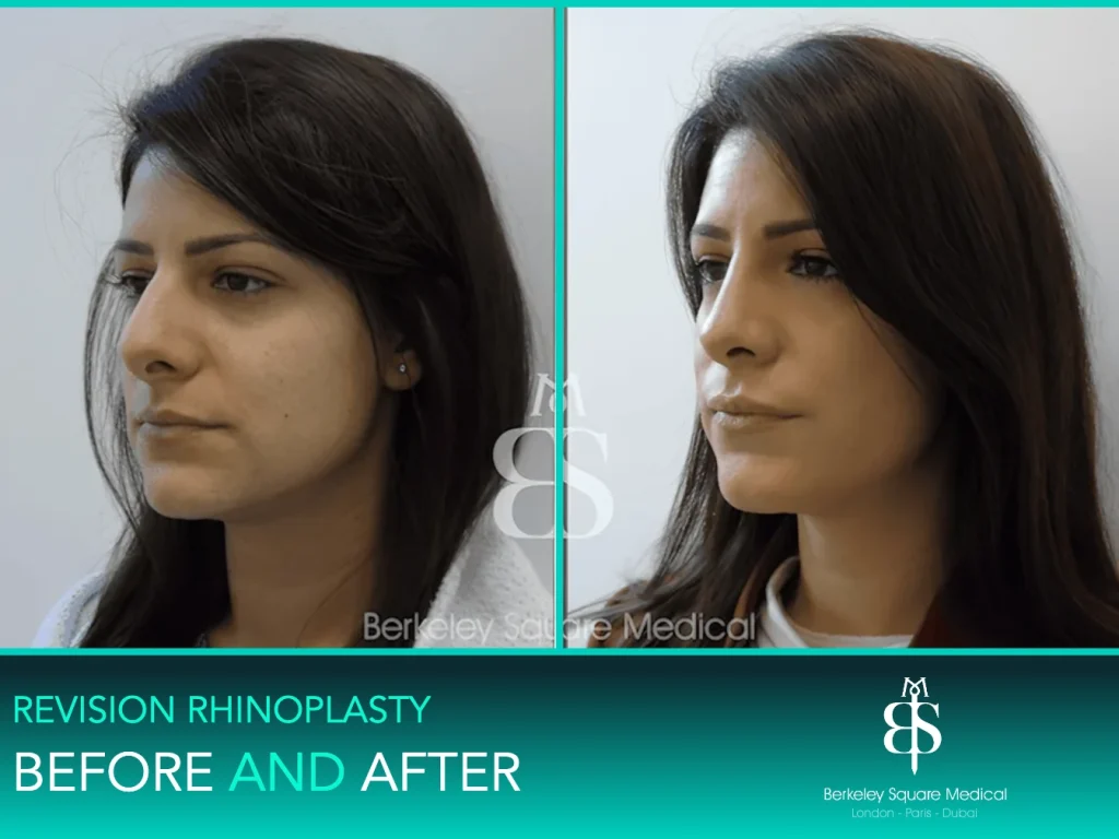 Revision rhinoplasty before and after, three-quarter view: straighter bridge and a lifted, refined tip, Mr Taimur Shoaib, London