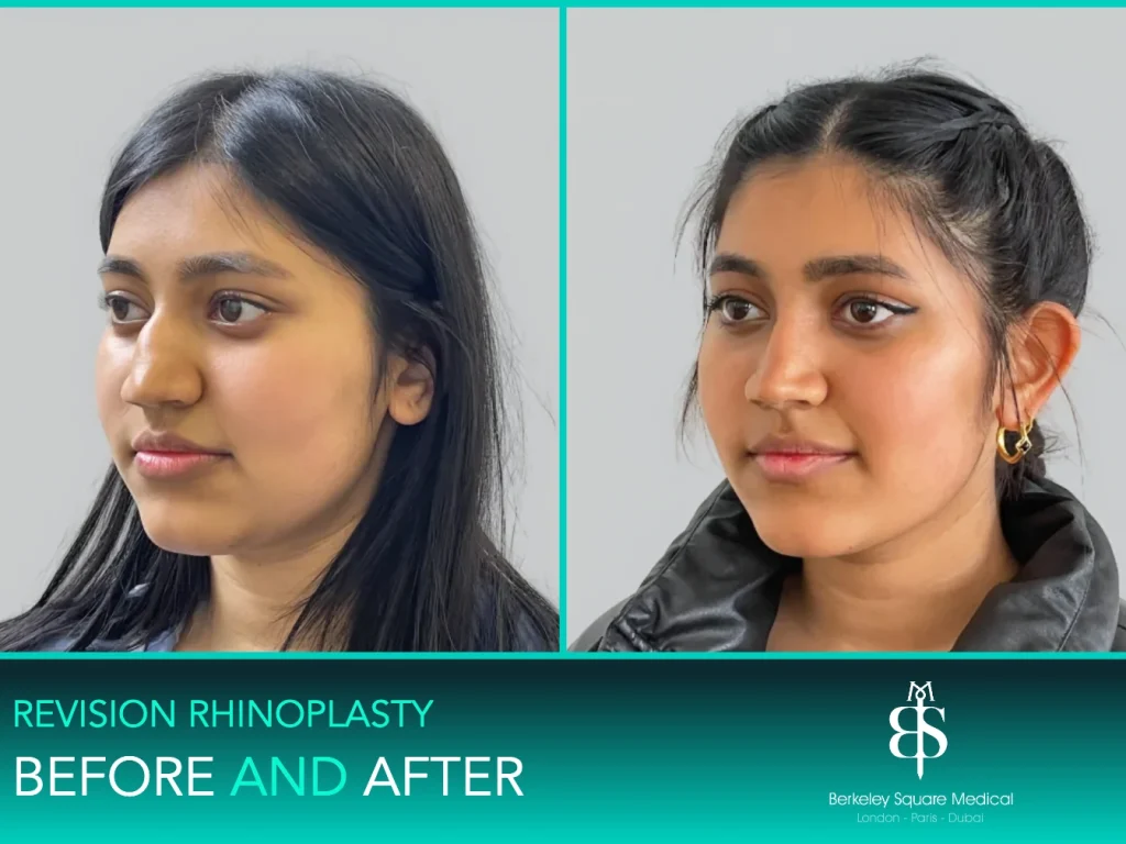 Revision rhinoplasty before and after, three-quarter view: a slimmer, more refined nose and tip, Mr Taimur Shoaib, London