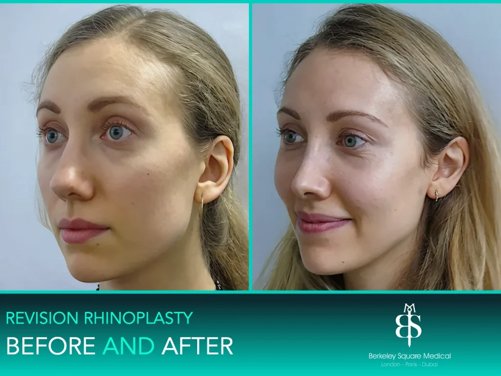 Revision rhinoplasty before and after, three-quarter view: a smoother, more natural bridge, Mr Taimur Shoaib, London
